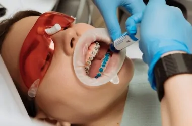 Активация брекетов: что это и как происходит | DENTART Активация брекетов: что это и как происходит