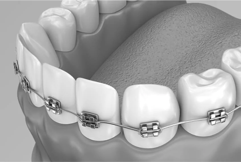 Вся правда про брекеты: больно ли и как долго носить? | DENTART Вся правда про брекеты: больно ли и как долго носить?