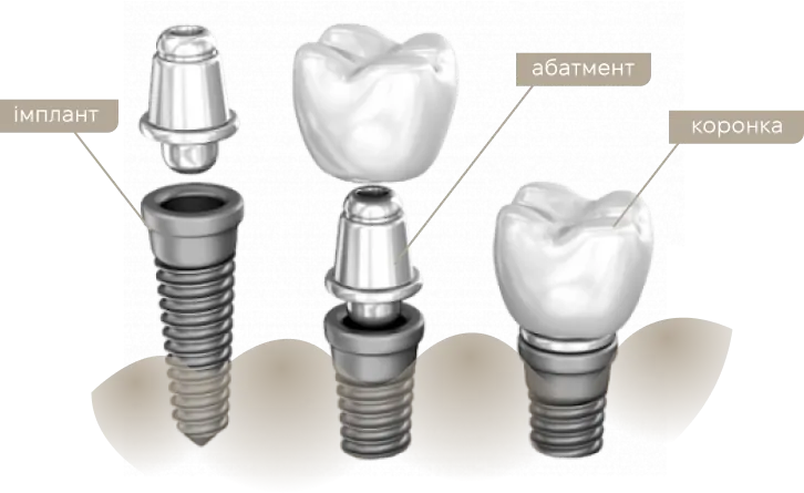Что такое имплант зуба? Из чего он состоит? | DENTART Что такое имплант зуба? Из чего он состоит?