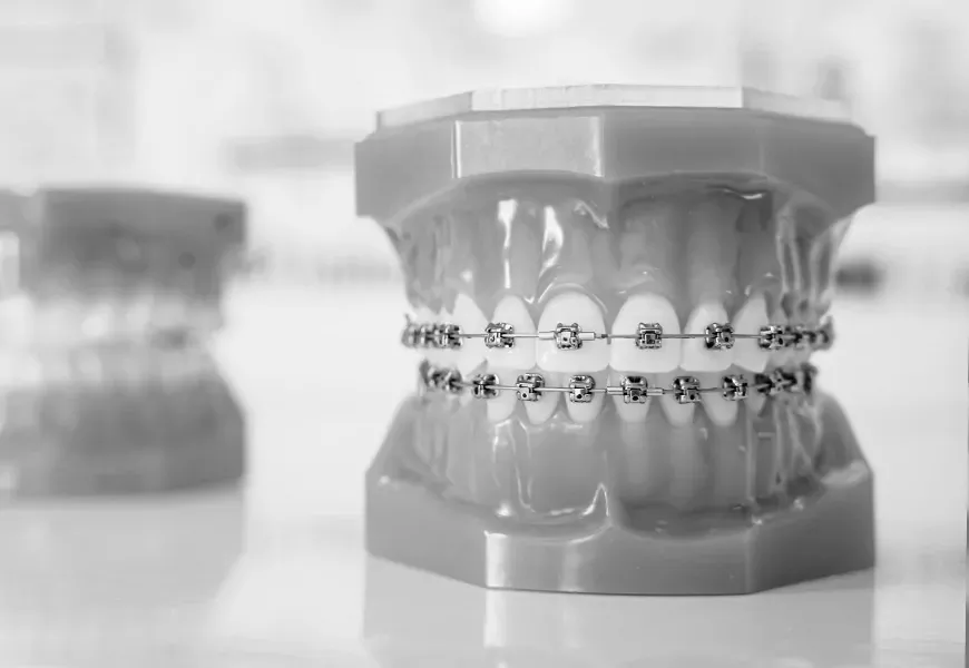 Самолигирующие брекеты | DENTART Самолигирующие брекеты