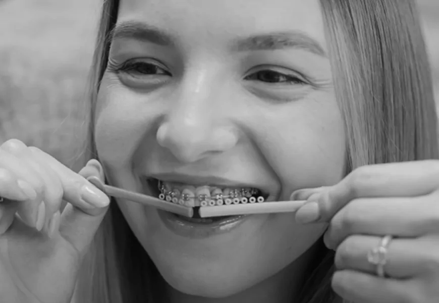 Лигатурные брекет-системы | DENTART Лигатурные брекет-системы