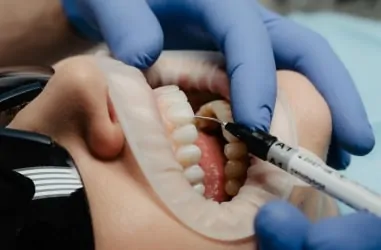 Виниры: виды, цены, особенности установки | DENTART Виниры: виды, цены, особенности установки