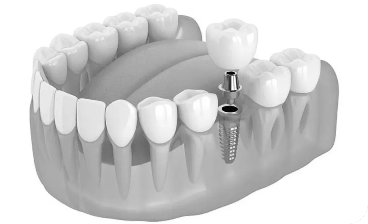 Протезирование на имплантатах | DENTART Протезирование на имплантатах