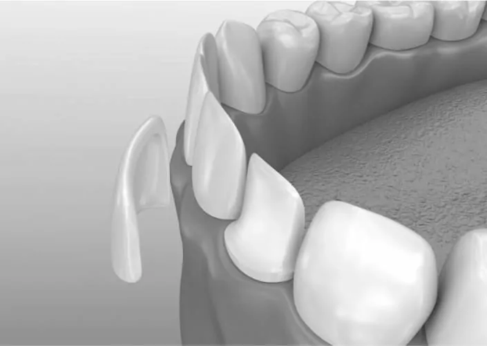 Виниры на зубы | DENTART Виниры на зубы