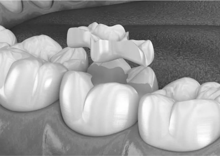 Керамические накладки | DENTART Керамические накладки