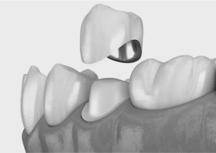 Коронки на зубы | DENTART Коронки на зубы