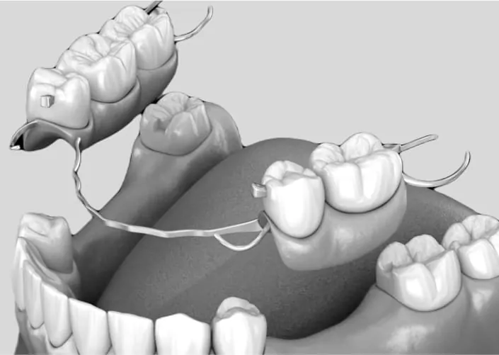 Съемные протезы | DENTART Съемные протезы