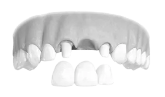 Этапы протезирования зубов Препарирование | DENTART Этапы протезирования зубов Препарирование